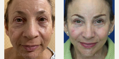 Woman treated with Facelift - woman treated with Rhinoplasty