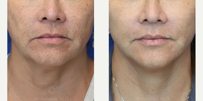 Woman treated with Facelift - woman treated with Rhinoplasty