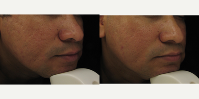 45-54 year old man treated with Intracel - Patient did a series of 3 Intracel treatments.