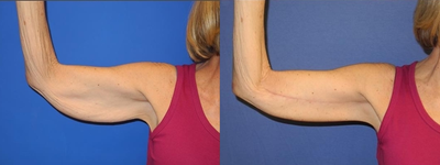Arm Lift - Woman treated with Arm Lift