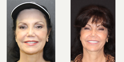 65-74 year old woman treated with Dental Implants - Full mouth rehab, 28 porcelain restorations. Dental implant to replace front tooth. Patient came to Dr. Young with excruciating TMJ symptoms, as well as a concern for her oral health. Dr. Young was able to restore the patient's bite for function, as well as aesthetic. We couldn't be happier!