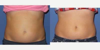 39 year old woman treated with SculpSure to the abdomen   - A 39 y/o female who underwent SculpSure treatment to her abdomen is shown