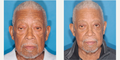 65-74 year old man treated with Eyelid Surgery, Eyelid Retraction Repair, Double Eyelid Surgery - 67-year-old man treated with Upper and Lower Blepharoplasty and Ptosis Repair.Time After Surgery: 1 Month