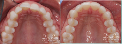 45-54 year old woman treated with Lingual Braces - Inside lingual braces to correct alignment of top front teeth in adult female patient. Treatment completed in 4 months.