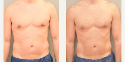 48 year old man treated with SAFELipo - 48 year old man treated with Liposuction of the abdomen