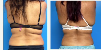 35-44 year old woman treated with CoolSculpting - 42 year old with 1 treatment of CoolSculpting to the Love handles, Bra Roll and Abdomen