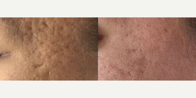 Woman treated with SkinPen - Woman treated with SkinPen