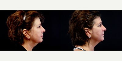 57 year old woman treated with Thread Lift - 57 year old woman treated with Thread Lift. Photos depict before and 1 month after 8 Silhouette Instalift Sutures.