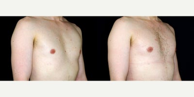 35 year old man treated with Breast Fat Transfer for enhanced size and symmetry. - 35 year old man treated with Breast Fat Transfer for enhanced size and symmetry. Photos depict before and 1 month after surgery.