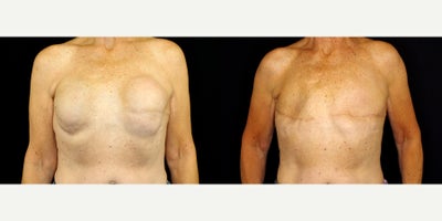 67 year old woman treated with Breast Implant Removal (Flat Closure) - 67 year old woman treated with Breast Implant Removal (Flat Closure) . Photos depict before and 3 months after surgery.