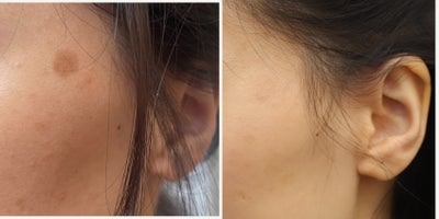 25-34 year old woman treated with PicoSure - 25-34 year old woman treated with PicoSure