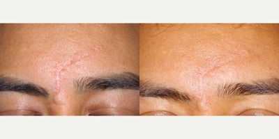 31 year old man treated with Scar Removal - 31 year old man treated with 6 IPL treatments for Scar Revision