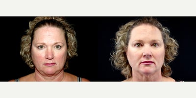 58 year old woman treated with Thread Lift - 58 year old woman treated with Thread Lift. Photos depict before and 3 months after 6 Instalift Sutures