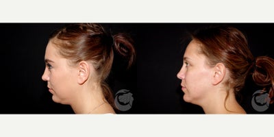 27 year old woman treated with CoolMini to the chin. - 27 year old woman treated with CoolMini to the chin. Photos depict before and 2 months after treatment.