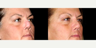 43 year old woman treated with Cleft Lip And Cleft Lip Revision. - 43 year old woman treated with Cleft Lip And Cleft Lip Revision. Photos depict before and 9 months after surgery.