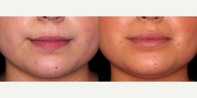 21 year old woman treated with Restylane Kysse to the lips - 21 year old woman treated with Restylane Kysse to the lipsPhotos depict before and 2 weeks after treatment.