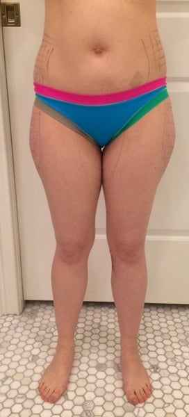 30yrs Old - 36DDD/F to 36C? - Review - RealSelf