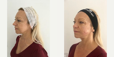 55-64 year old woman treated with Ellanse - Rejuvenation to mid face using the collagen stimulator Ellanse2mls per side optimal results will be seen at 3 months