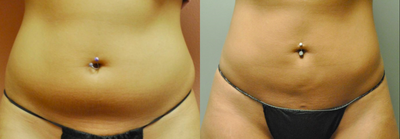 35-44 year old woman treated with Tickle Lipo - Abdomen