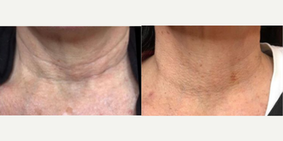 45-54 year old woman treated with Botox - Patient was treated with Microbotox on the neck to help smooth lines and tighten skin.