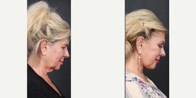 65-74 year old woman treated with Facelift, Neck Lift - face and neck lift 3 months post op.