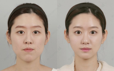 25-34 year old woman treated with V Line Surgery - No tie double jaw surgery + Square Jaw Surgery in ID hospital