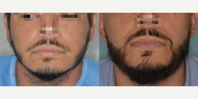 35-44 year old man treated with Beard Transplant - Before and after 1900 FUE grafts to beard.