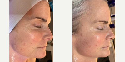 Woman treated with HydraFacial - Woman treated with HydraFacial for deep cleaning as well as restore moisture and diminish wrinkles and folds