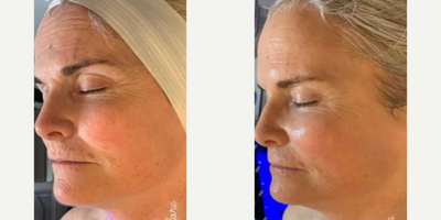 Woman treated with HydraFacial - Woman treated with HydraFacial for deep cleaning as well as restore moisture and diminish wrinkles and folds