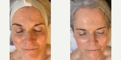 Woman treated with HydraFacial - Woman treated with HydraFacial for deep cleaning as well as restore moisture and diminish wrinkles and folds