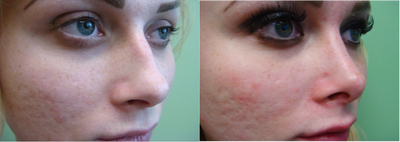 25-34 year old male treated with Facial Feminization Surgery - Cosmetic Rhinoplasty