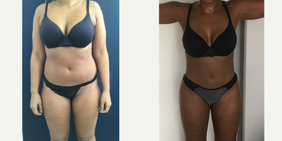 25-34 year old woman treated with Liposuction - Amazing post op results in this 32 year old patient from New York two months after 360 liposuction and Brazilian butt lift with Premium Care. Surgical time was minimized using two plastic surgeons, and she spent 10 days after surgery recovering in Cartagena at our five star Recovery Suites. Her figure looks amazing!