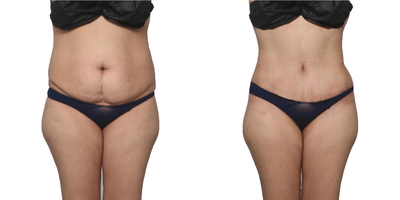 Woman treated with Smart Lipo - This 36-year-old mom was done having children and wanted her potbelly gone, her waistline snatched, and her booty fuller. She was treated with lipo 360 - abdomen, flanks, and back, fat transfer to the hips and buttocks, and a tummy tuck with muscle plication, diastasis repair, and a scarless belly button. Back to work in 3 weeks and super happy.
