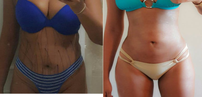 25-34 year old woman treated with Liposuction - 25-34 year old woman treated with Liposuction