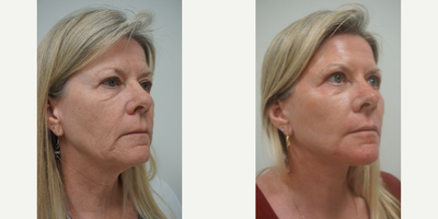 55-64 year old woman treated with Renuvion - 59-year-old female from Queen Creek, AZ. She visited our Gilbert office near Scottsdale, AZ. She was concerned with facial aging and wanted to restore a more youthful look as well as erase lines and wrinkles and restore volume to her face. Dr Olson perormed a lower face lift with full face J plasma and fat transfer.Photos were taken 8 weeks post procedure.