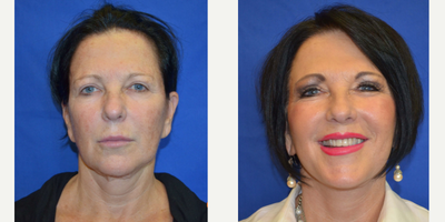 55-64 year old woman treated with Skin Tightening - This patient came to our practice wanting to rejuvenate her appearance for her career and personal life. After visiting with Dr. Ho, the patient elected to have a face/neck lift and laser skin resurfacing procedure.