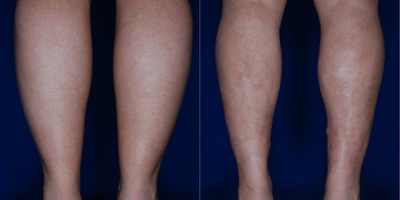 35-44 year old woman treated with Calf Reduction - Liposuction to reduce the calf