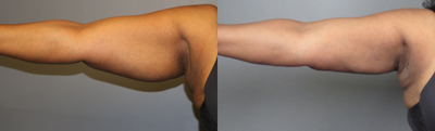 45-54 year old woman treated with BodyTite - BODYTITE AND LIPOSUCTION OF THE ARMS