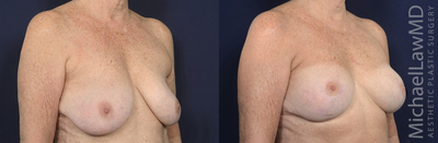 65-74 year old woman treated with Sientra Breast Implants - Augmentation mastopexy. Follow-up photo taken 1 year after the procedure.