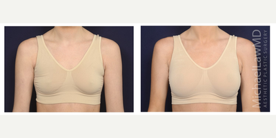 25-34 year old woman treated with Mentor Breast Implants - Breast augmentation. Follow-up photo taken 3 months after the procedure.