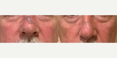 Man treated with PicoSure - Man treated with PicoSure.