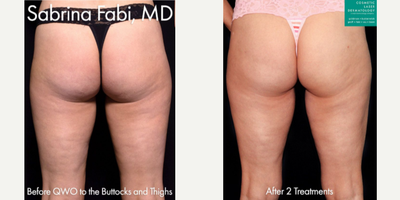 25-34 year old woman treated with Qwo - Qwo injections used to treat cellulite on the buttocks by Dr. Fabi.