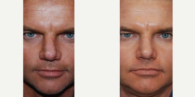 Non-Surgical Rhinoplasty Before & After: Correction of Asymmetries and Cleft Tip After Prior Surgery - Our handsome 40 year old patient was dissatisfied with the appearance of his nose after previous rhinoplasty, many years ago. You can see that he has very thin nasal skin, with a cleft in the middle of his tip, and significant nasal tip asymmetries that have many stigmata of previous rhinoplasty surgery. His after photos are following three treatments with microdroplet Silikon-1000, over a 6-month period, to create a less operated-looking, and more symmetrical nasal tip appearance, without the expense, inconvenience, downtime, and uncertainty associated with revision rhinoplasty surgery. Microdroplet Silikon-1000 has a 60-year history of safety, precision, and permanence, when used for permanent non-surgical nose job treatments. Additionally, since a Silikon-1000 molecule is smaller than that of a red blood cell, problems like necrosis, embolus, blindness, stroke, infection, and biofilm, simply do not occur, as they may with temporary gel fillers like HA.