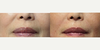 55-64 year old woman treated with Juvederm, Vollure - Treatment of nasolabial folds (laugh lines) and marionette lines with Juvederm, Radiesse, Vollure, Restylane or Bellafill injected with cannula