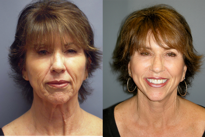 LiteLift, Platysmaplasty, Blue Peel on 62-year-old Woman - This 62-year-old woman had a LiteLift&trade; and Platysmaplasty. Obagi Blue Peel was applied following her surgical procedure.&nbsp;