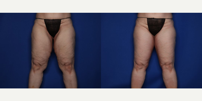 42 year old woman treated with Thigh Lift - 42 year old woman treated with Thigh Lift