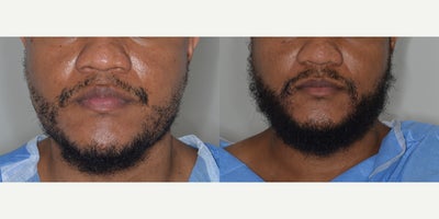 35-44 year old man treated with FUE Hair Transplant - 30 year old male patient desiring a fuller beard.  Before and after 2,000 FUE graft to the beard