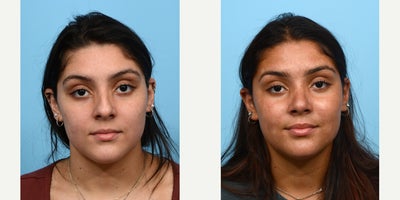 18-24 year old woman treated with Septoplasty - Dr. Wise corrected a large dorsal hump and a drooping nasal tip for this patient. 4 months after her rhino- and septoplasty surgery, she loves her new nose and finds it improves the overall symmetry of her face.
