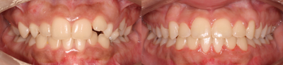 Clear Braces: Simple case with nice results - This patient's parents were mainly concerned before orthodontics with the upper front tooth that came in very out of place. Clear braces were used for a short period of time to straighten the upper and lower front teeth and perfect the bite.