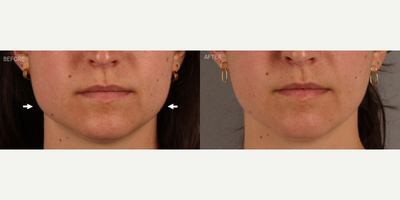 Masseter Botox for TMJ / Jawline Slimming - 27-year-old female who presented complaining that her face had become more square, corresponding to pain and tooth damage from grinding and clenching her teeth. She is shown 6 weeks after neurotoxin (Botox) treatment to these muscles, resulting in jawline slimming and a more heart-shaped face. She also has complete relief from her symptoms related to teeth grinding and clenching.